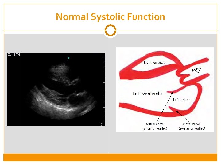 Normal Systolic Function 