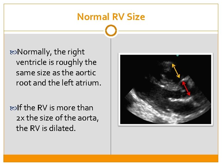 Normal RV Size Normally, the right ventricle is roughly the same size as the