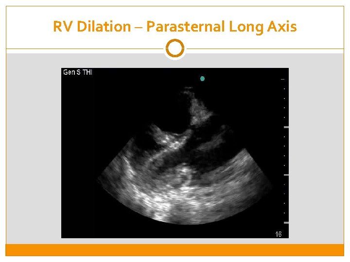 RV Dilation – Parasternal Long Axis 