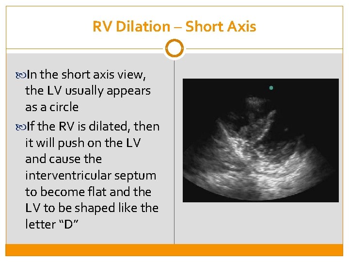 RV Dilation – Short Axis In the short axis view, the LV usually appears