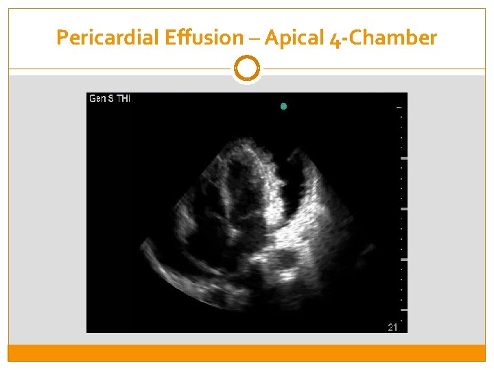 Pericardial Effusion – Apical 4 -Chamber 