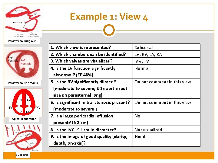 Example 1: View 4 Parasternal long axis Parasternal short axis RV LV TV MV