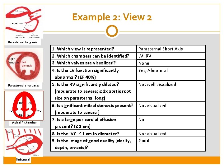 Example 2: View 2 Parasternal long axis Parasternal short axis RV LV TV MV