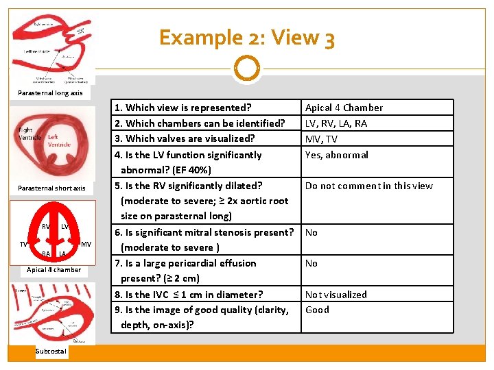 Example 2: View 3 Parasternal long axis Parasternal short axis RV LV TV MV