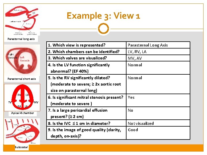 Example 3: View 1 Parasternal long axis Parasternal short axis RV LV TV MV