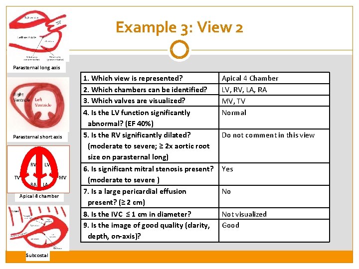 Example 3: View 2 Parasternal long axis Parasternal short axis RV LV TV MV