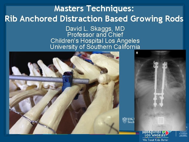 Masters Techniques: Rib Anchored Distraction Based Growing Rods David L. Skaggs, MD Professor and