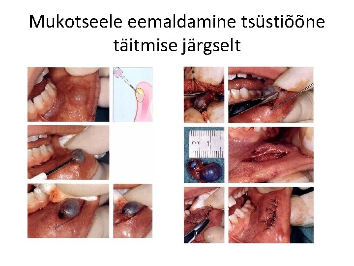 Mukotseele eemaldamine tsüstiõõne täitmise järgselt 