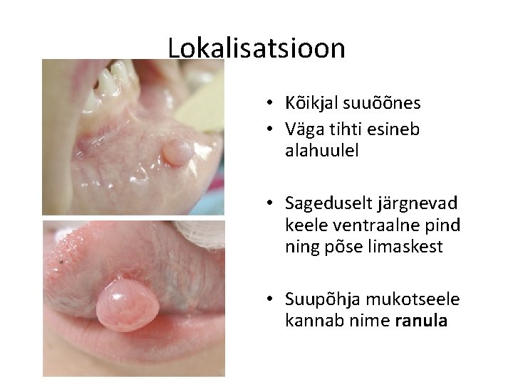 Lokalisatsioon • Kõikjal suuõõnes • Väga tihti esineb alahuulel • Sageduselt järgnevad keele ventraalne