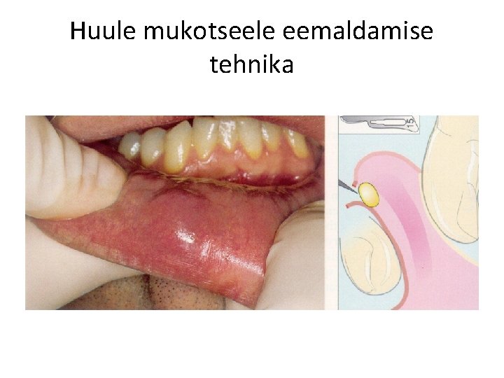 Huule mukotseele eemaldamise tehnika 