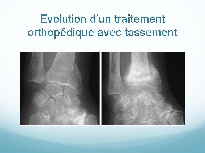 Evolution d’un traitement orthopédique avec tassement 