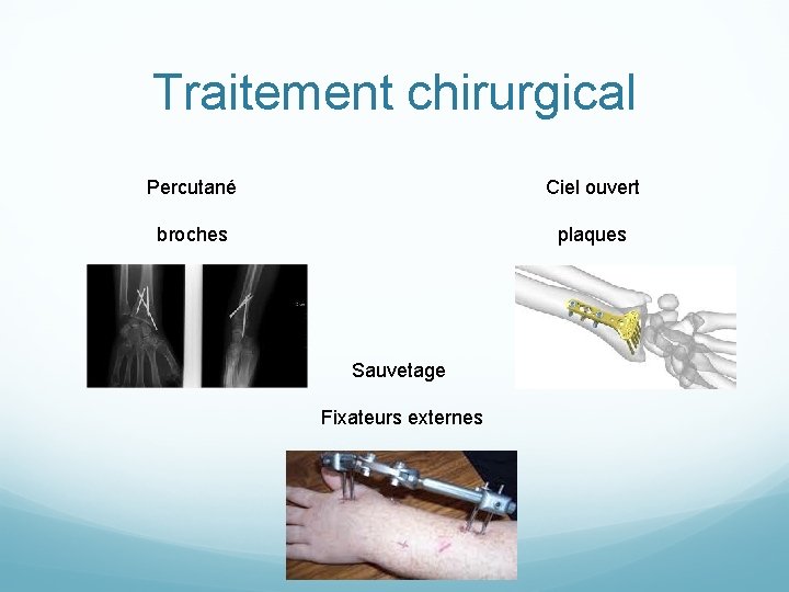 Traitement chirurgical Percutané Ciel ouvert broches plaques Sauvetage Fixateurs externes 
