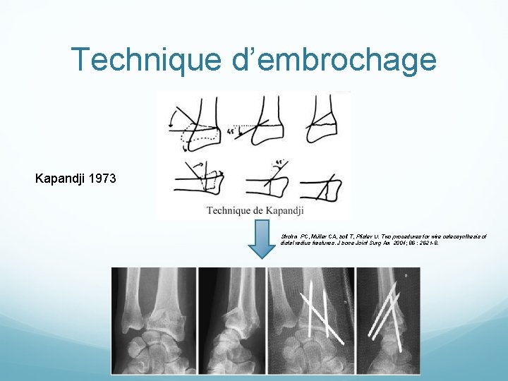 Fractures de lextrmit distale du radius de la