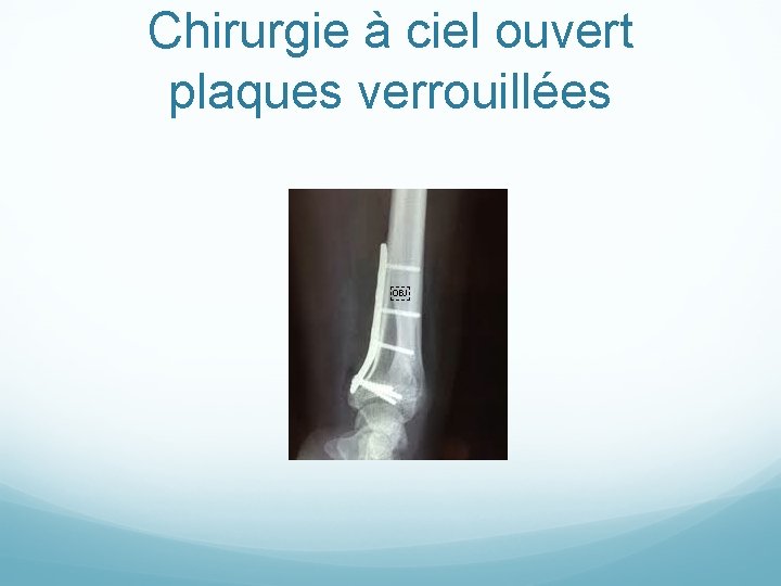 Chirurgie à ciel ouvert plaques verrouillées ￼ 