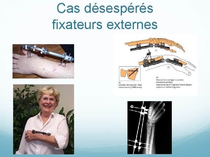 Cas désespérés fixateurs externes 