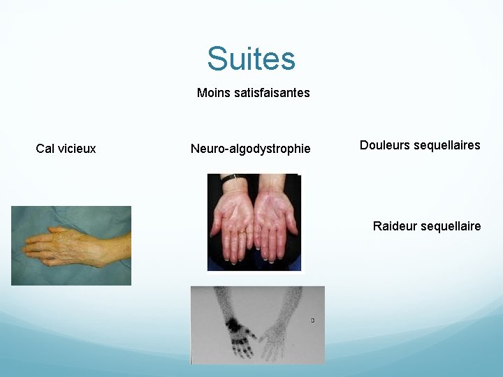 Suites Moins satisfaisantes Cal vicieux Neuro-algodystrophie Douleurs sequellaires Raideur sequellaire 