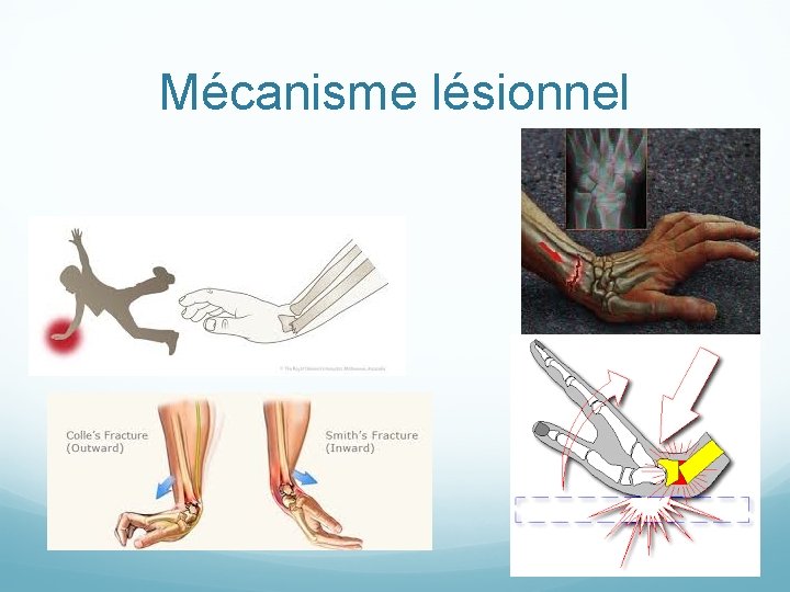 Mécanisme lésionnel 