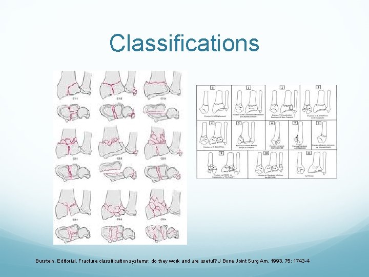 Classifications Burstein. Editorial. Fracture classification systems: do they work and are useful? J Bone