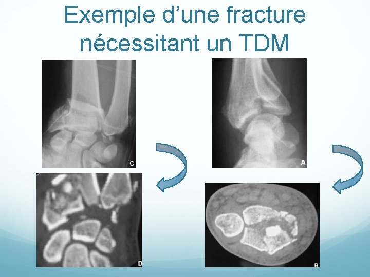 Exemple d’une fracture nécessitant un TDM 