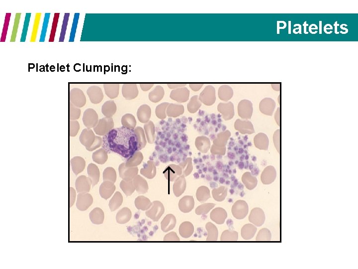 Platelets Platelet Clumping: 