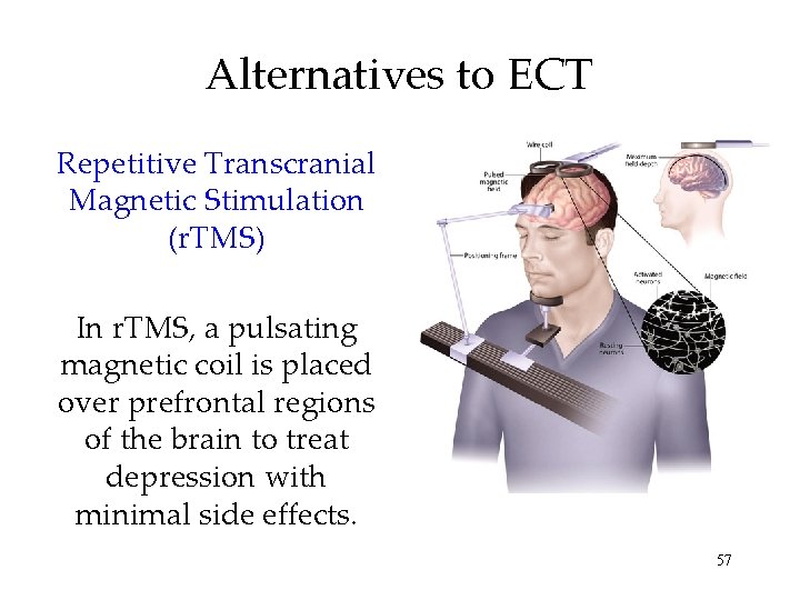 Alternatives to ECT Repetitive Transcranial Magnetic Stimulation (r. TMS) In r. TMS, a pulsating