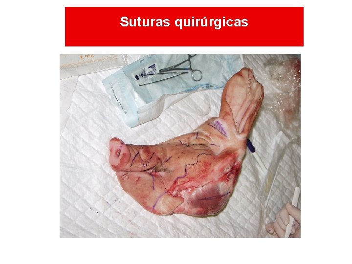Prólogo (1) Suturas quirúrgicas Prólogo (1) Suturas quirúrgicas