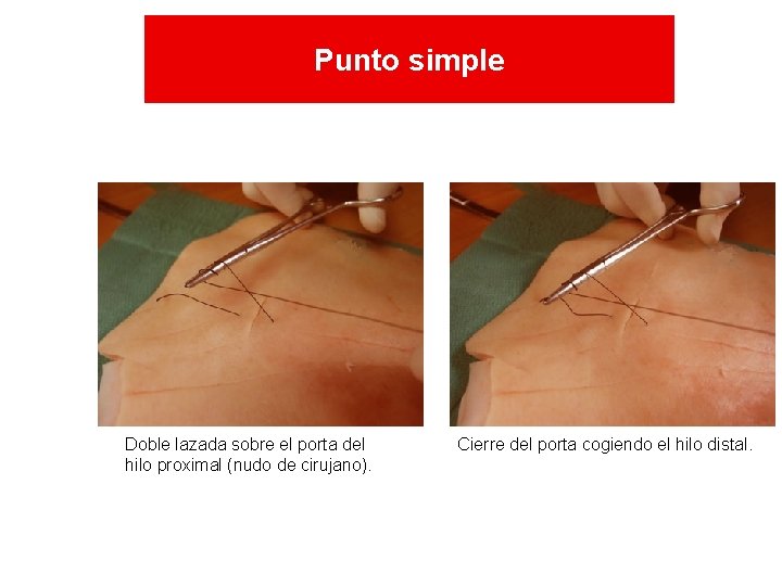 Punto simple Doble lazada sobre el porta del hilo proximal (nudo de cirujano). Cierre Punto simple Doble lazada sobre el porta del hilo proximal (nudo de cirujano). Cierre