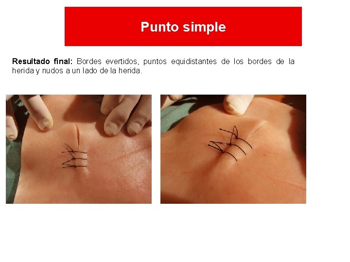 Punto simple Resultado final: Bordes evertidos, puntos equidistantes de los bordes de la herida Punto simple Resultado final: Bordes evertidos, puntos equidistantes de los bordes de la herida