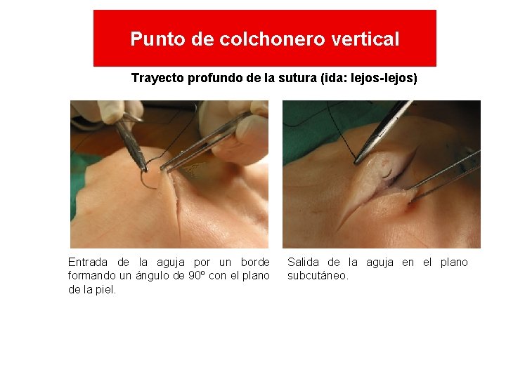 Punto de colchonero vertical Trayecto profundo de la sutura (ida: lejos-lejos) Entrada de la Punto de colchonero vertical Trayecto profundo de la sutura (ida: lejos-lejos) Entrada de la