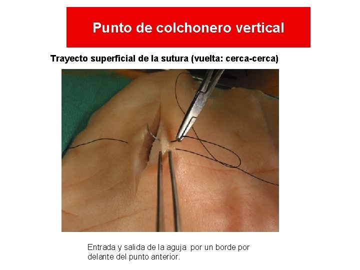 Punto de colchonero vertical Trayecto superficial de la sutura (vuelta: cerca-cerca) Entrada y salida Punto de colchonero vertical Trayecto superficial de la sutura (vuelta: cerca-cerca) Entrada y salida