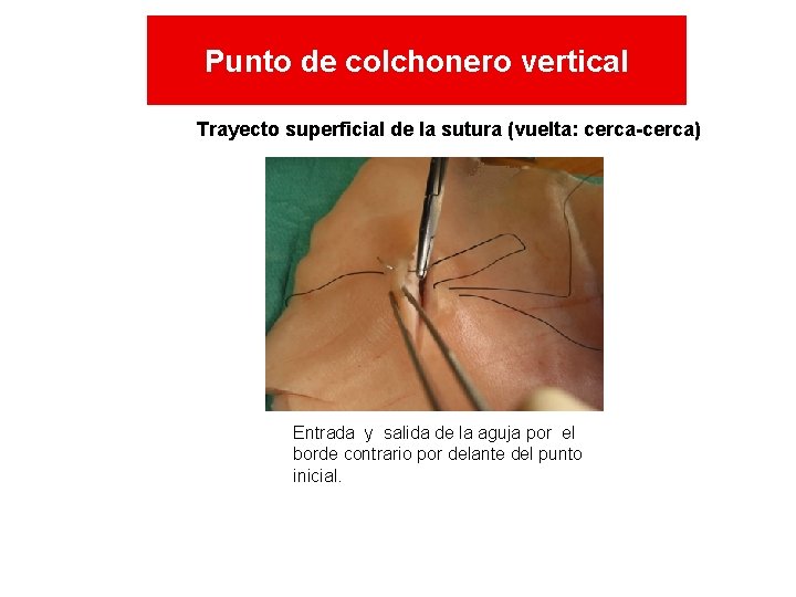 Punto de colchonero vertical Trayecto superficial de la sutura (vuelta: cerca-cerca) Entrada y salida Punto de colchonero vertical Trayecto superficial de la sutura (vuelta: cerca-cerca) Entrada y salida