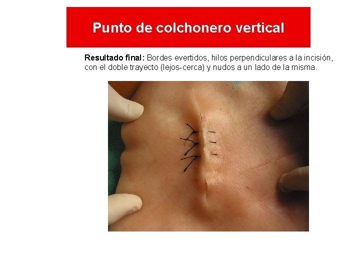 Punto de colchonero vertical Resultado final: Bordes evertidos, hilos perpendiculares a la incisión, con Punto de colchonero vertical Resultado final: Bordes evertidos, hilos perpendiculares a la incisión, con