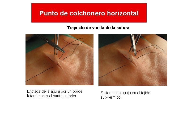 Punto de colchonero horizontal T Trayecto de vuelta de la sutura. Entrada de la Punto de colchonero horizontal T Trayecto de vuelta de la sutura. Entrada de la