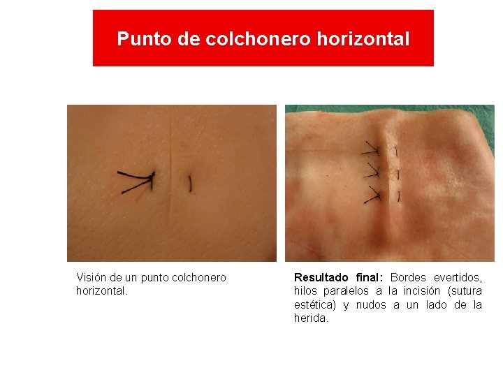 Punto de colchonero horizontal Visión de un punto colchonero horizontal. Resultado final: Bordes evertidos, Punto de colchonero horizontal Visión de un punto colchonero horizontal. Resultado final: Bordes evertidos,