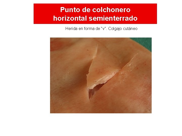 Punto de colchonero horizontal semienterrado Herida en forma de “v”. Colgajo cutáneo Punto de colchonero horizontal semienterrado Herida en forma de “v”. Colgajo cutáneo