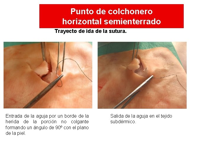 Punto de colchonero horizontal semienterrado Trayecto de ida de la sutura. Entrada de la Punto de colchonero horizontal semienterrado Trayecto de ida de la sutura. Entrada de la
