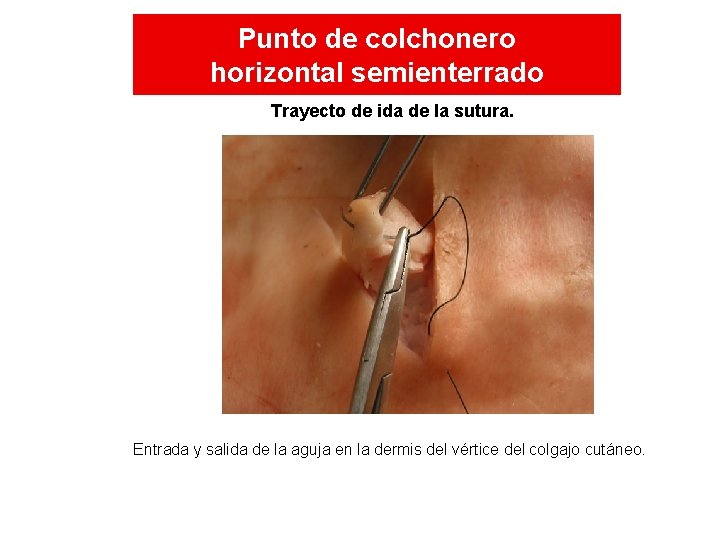 Punto de colchonero horizontal semienterrado Trayecto de ida de la sutura. Entrada y salida Punto de colchonero horizontal semienterrado Trayecto de ida de la sutura. Entrada y salida