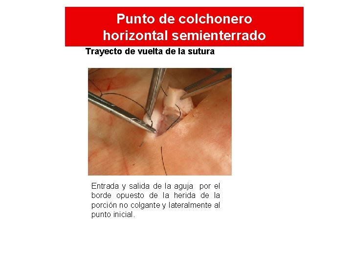 Punto de colchonero horizontal semienterrado Trayecto de vuelta de la sutura Entrada y salida Punto de colchonero horizontal semienterrado Trayecto de vuelta de la sutura Entrada y salida