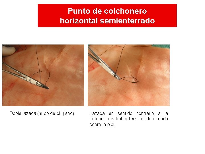 Punto de colchonero horizontal semienterrado Doble lazada (nudo de cirujano). Lazada en sentido contrario Punto de colchonero horizontal semienterrado Doble lazada (nudo de cirujano). Lazada en sentido contrario