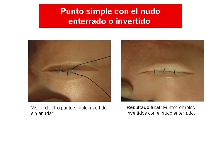 Punto simple con el nudo enterrado o invertido Visión de otro punto simple invertido Punto simple con el nudo enterrado o invertido Visión de otro punto simple invertido