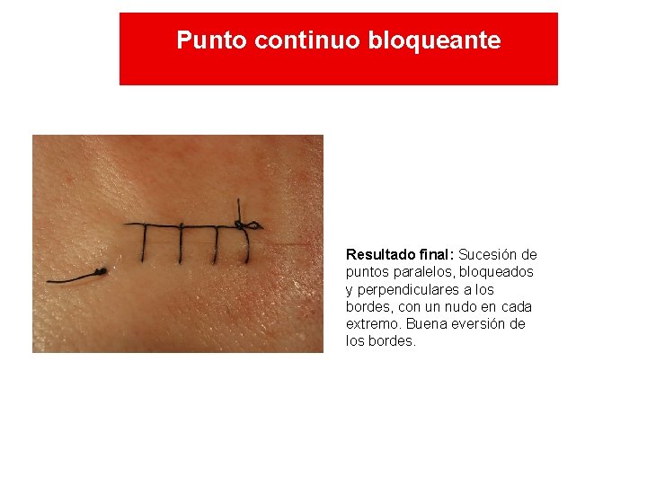 Punto continuo bloqueante Resultado final: Sucesión de puntos paralelos, bloqueados y perpendiculares a los Punto continuo bloqueante Resultado final: Sucesión de puntos paralelos, bloqueados y perpendiculares a los