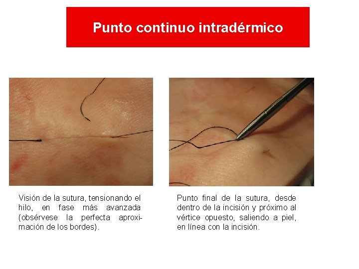 Punto continuo intradérmico Visión de la sutura, tensionando el hilo, en fase más avanzada Punto continuo intradérmico Visión de la sutura, tensionando el hilo, en fase más avanzada