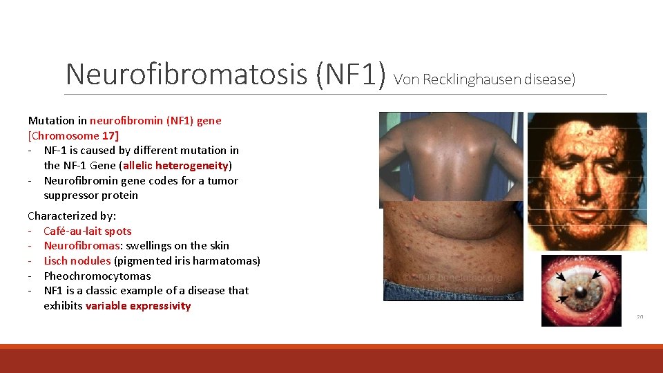 Neurofibromatosis (NF 1) Von Recklinghausen disease) Mutation in neurofibromin (NF 1) gene [Chromosome 17]
