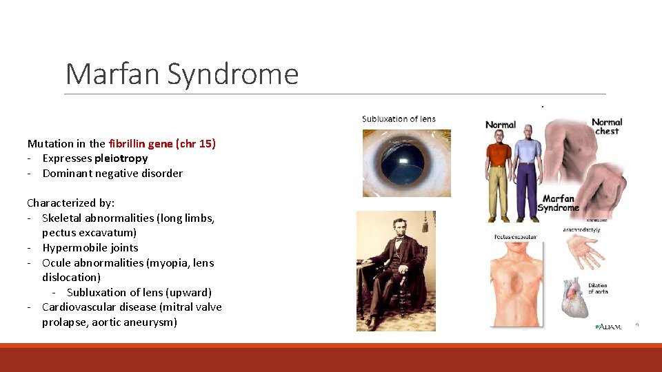Marfan Syndrome Mutation in the fibrillin gene (chr 15) - Expresses pleiotropy - Dominant Marfan Syndrome Mutation in the fibrillin gene (chr 15) - Expresses pleiotropy - Dominant
