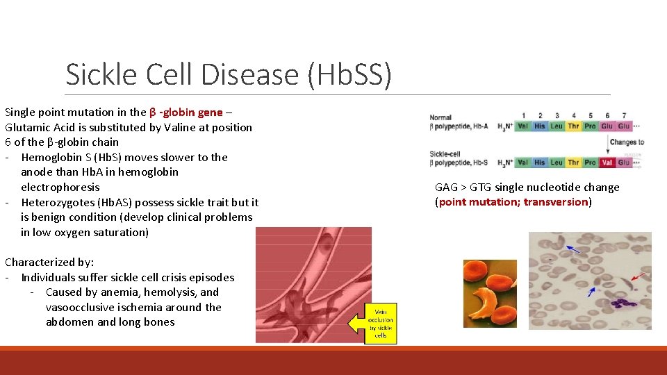 Sickle Cell Disease (Hb. SS) Single point mutation in the β -globin gene – Sickle Cell Disease (Hb. SS) Single point mutation in the β -globin gene –