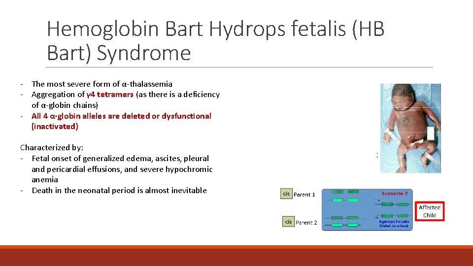 Hemoglobin Bart Hydrops fetalis (HB Bart) Syndrome - The most severe form of α-thalassemia Hemoglobin Bart Hydrops fetalis (HB Bart) Syndrome - The most severe form of α-thalassemia