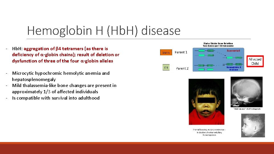 Hemoglobin H (Hb. H) disease - Hb. H: aggregation of β 4 tetramers (as Hemoglobin H (Hb. H) disease - Hb. H: aggregation of β 4 tetramers (as