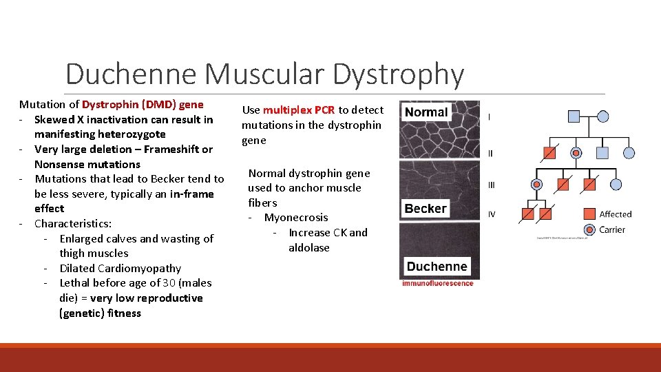 Duchenne Muscular Dystrophy Mutation of Dystrophin (DMD) gene - Skewed X inactivation can result Duchenne Muscular Dystrophy Mutation of Dystrophin (DMD) gene - Skewed X inactivation can result