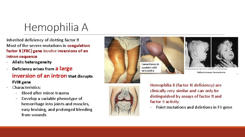 Hemophilia A Inherited deficiency of clotting factor 8 Most of the severe mutations in Hemophilia A Inherited deficiency of clotting factor 8 Most of the severe mutations in