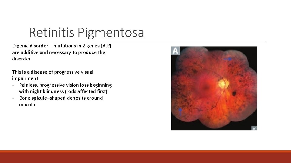 Retinitis Pigmentosa Digenic disorder – mutations in 2 genes (A, B) are additive and Retinitis Pigmentosa Digenic disorder – mutations in 2 genes (A, B) are additive and